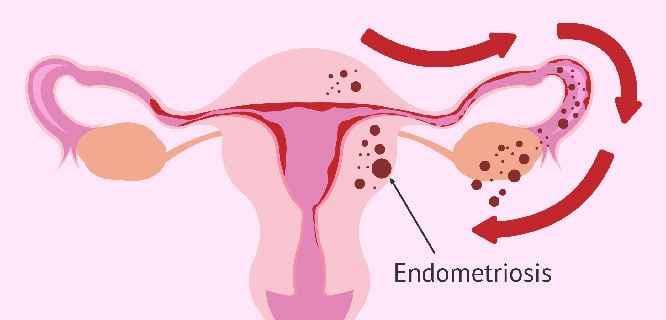 Endometriozis