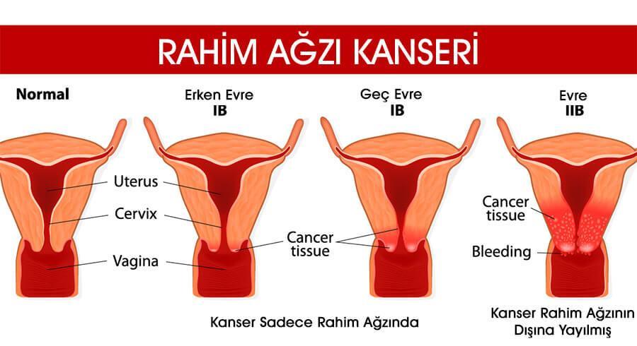 Rahim Ağzı Kanseri
