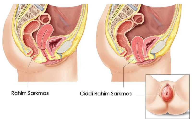 Rahimin Dışarıya Sarkması