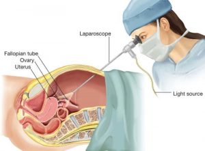 laparoskopik cerrahi
